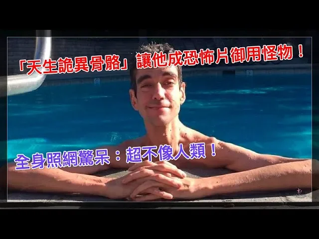 「天生詭異骨骼」讓他成恐怖片御用怪物!全身照網驚呆: 超不像人類!